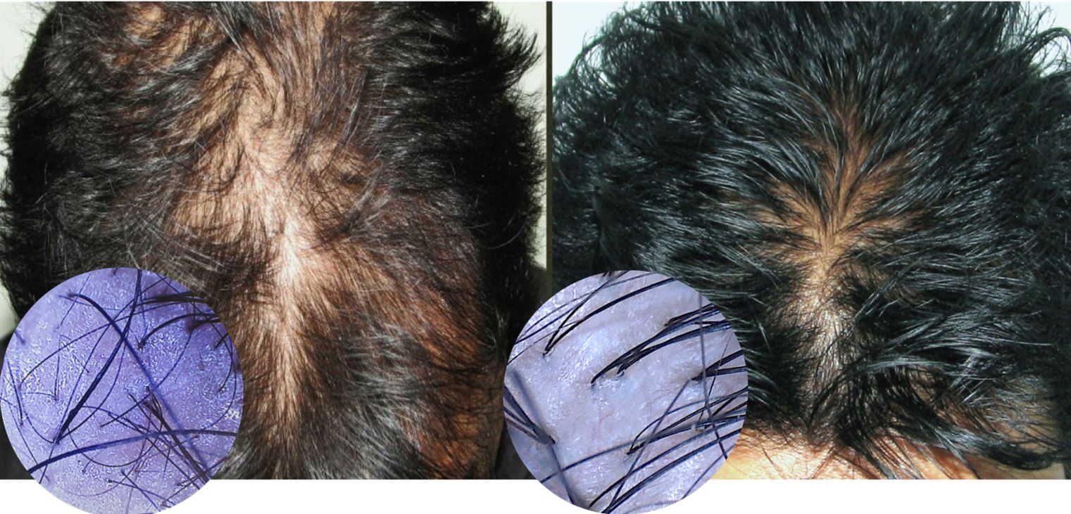 max's #1 mens hair regrowth treatment