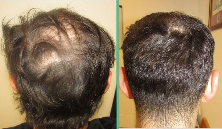 Hair Loss Treatment