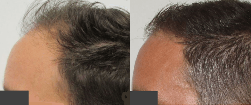 how long does hair regrowth take?