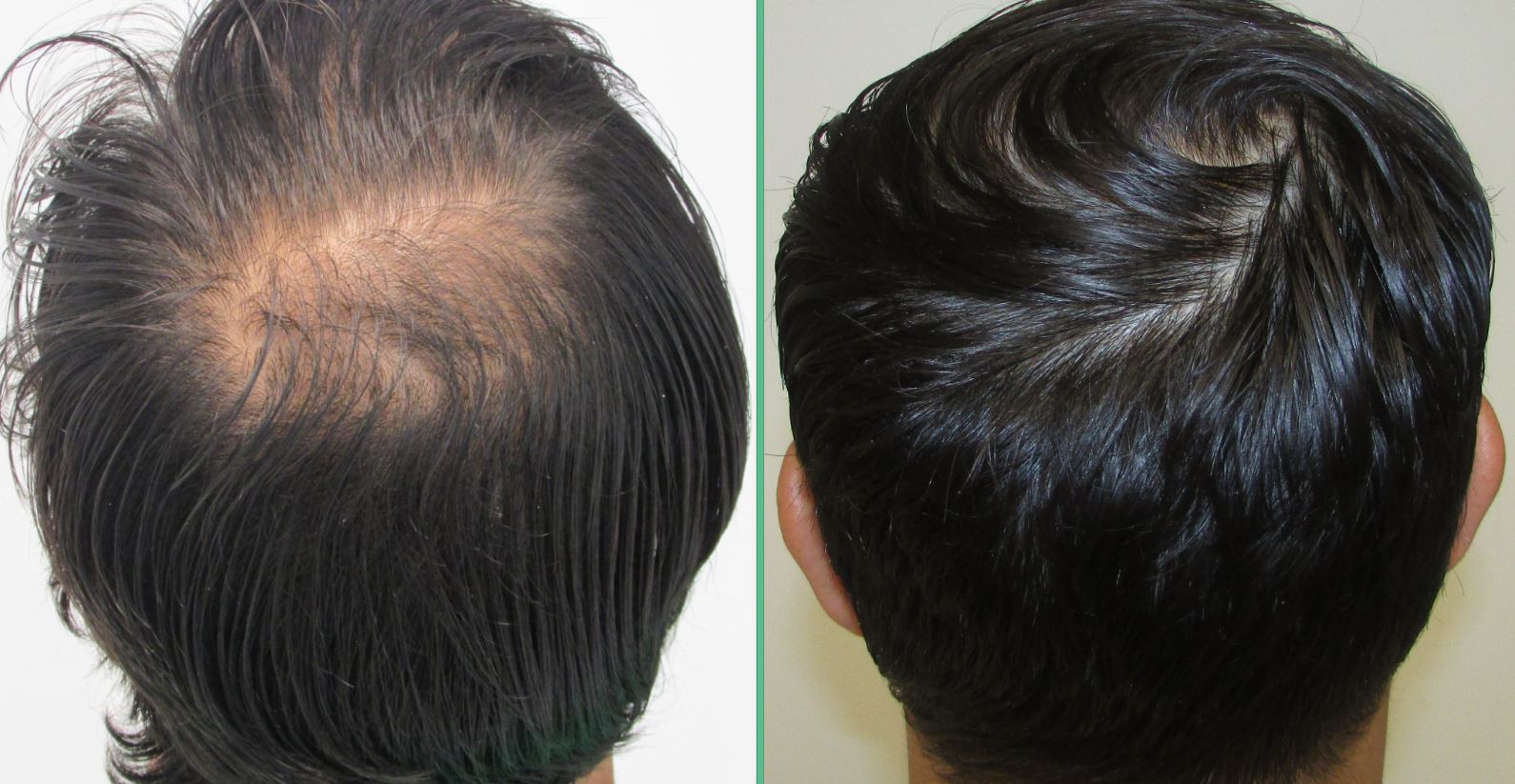 Best hair regrowth product