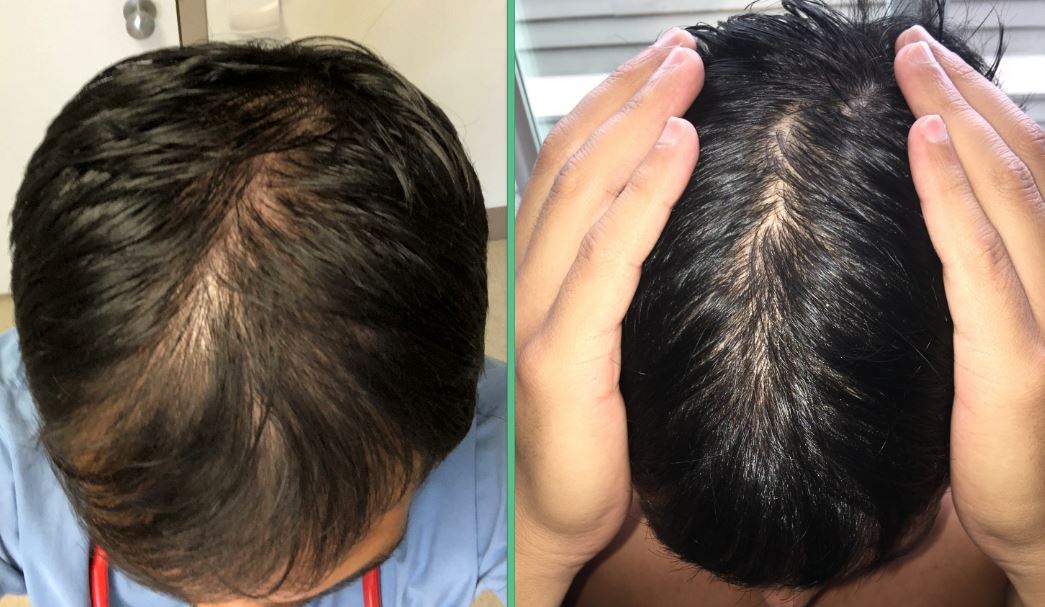 Best hair regrowth product