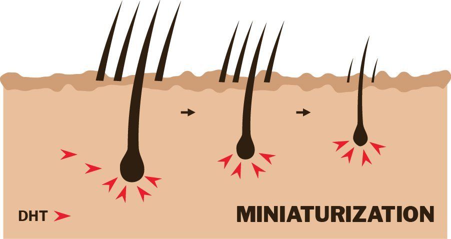 DHT causing miniaturization of the hair follicles