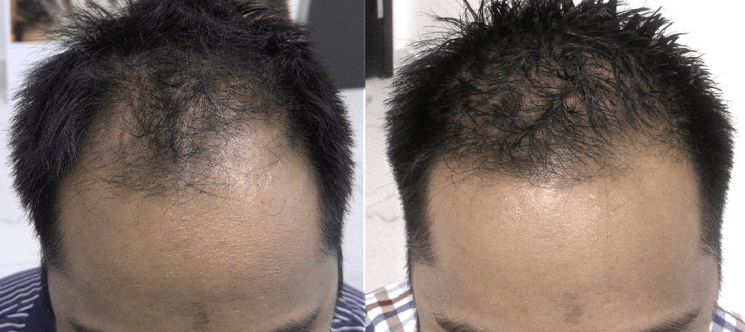 Best hair regrowth product