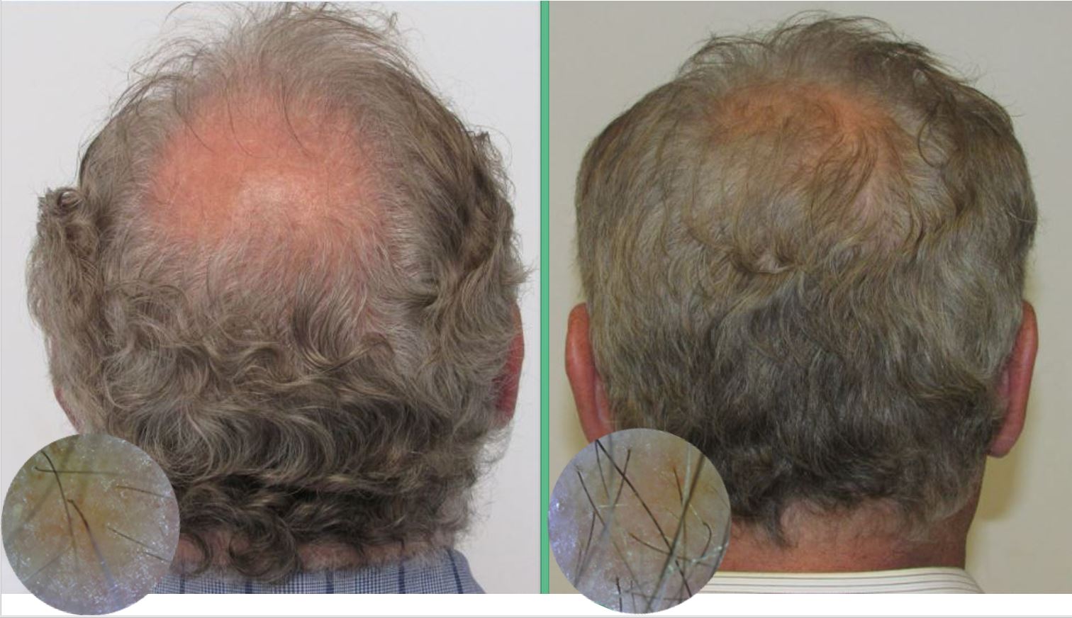 Hair Loss Treatment