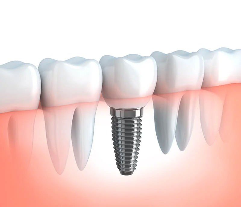 dental implants rancho cucamonga