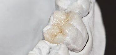 Inlay Crown—Cosmetic Dentistry in Fillmore, CA