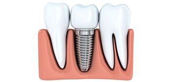 Implant Restoration—Cosmetic Dentistry in Fillmore, CA Implant Restoration—Cosmetic Dentistry in Fillmore, CA