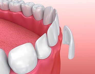 Dental Veneers—Cosmetic Dentistry in Fillmore, CA Dental Veneers—Cosmetic Dentistry in Fillmore, CA