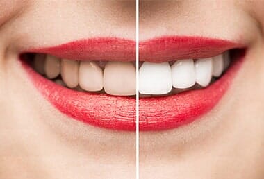 Teeth Whitening—Cosmetic Dentistry in Fillmore, CA Teeth Whitening—Cosmetic Dentistry in Fillmore, CA