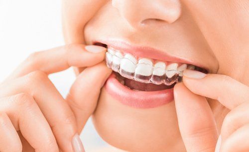 Invisalign -Beautiful Smile and White Teeth of a young Woman in Washington DC Invisalign -Beautiful Smile and White Teeth of a young Woman in Washington DC