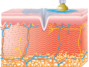 Graphic of new collagen creation after using TempSure Envi