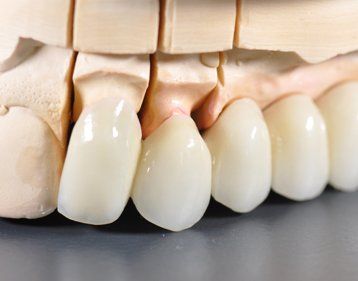 Model of dental crowns on a plaster cast.