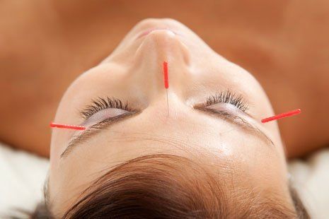 acupuncture migraine