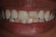 Before — Family dentists in Hampton, VA Before — Family dentists in Hampton, VA