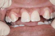 Before 2 — Family dentists in Hampton, VA Before 2 — Family dentists in Hampton, VA