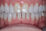 Before 3 — Family dentists in Hampton, VA Before 3 — Family dentists in Hampton, VA