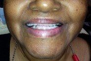 Before 4 — Family dentists in Hampton, VA Before 4 — Family dentists in Hampton, VA