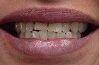 Before 5 — Family dentists in Hampton, VA Before 5 — Family dentists in Hampton, VA