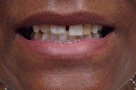 Before 6 — Family dentists in Hampton, VA Before 6 — Family dentists in Hampton, VA