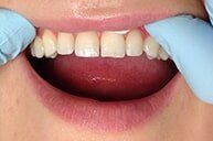 Before 7 — Family dentists in Hampton, VA Before 7 — Family dentists in Hampton, VA