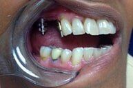Before 8 — Family dentists in Hampton, VA Before 8 — Family dentists in Hampton, VA