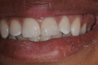 After — Family dentists in Hampton, VA After — Family dentists in Hampton, VA
