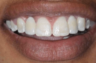 After 2 — Family dentists in Hampton, VA After 2 — Family dentists in Hampton, VA