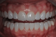 After 3 — Family dentists in Hampton, VA After 3 — Family dentists in Hampton, VA