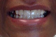 After 6 — Family dentists in Hampton, VA After 6 — Family dentists in Hampton, VA