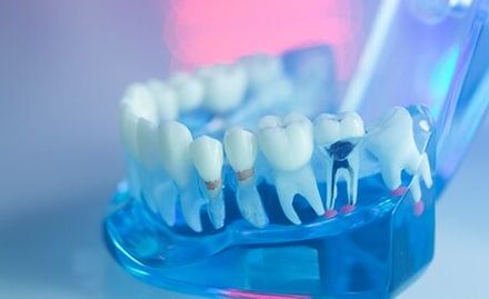 Dental Teeth, Mouth, Gums Dentists Teaching Model — Dental Office in Deerfield Beach, FL Dental Teeth, Mouth, Gums Dentists Teaching Model — Dental Office in Deerfield Beach, FL