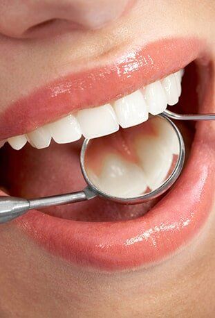 Dental Sealants — Dental Services in Deerfield Beach, FL Dental Sealants — Dental Services in Deerfield Beach, FL