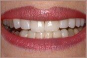 After Veneers — Veneers in Deerfield Beach, FL
