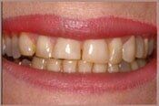 Before Veneers — Veneers in Deerfield Beach, FL