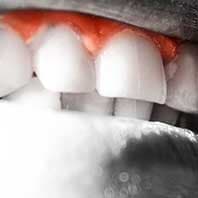 Teeth Gums — Dental Practice in Deerfield Beach, Fl Teeth Gums — Dental Practice in Deerfield Beach, Fl