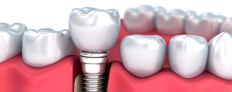 Tooth Implant — Dental Implants in Deerfield Beach, FL Tooth Implant — Dental Implants in Deerfield Beach, FL
