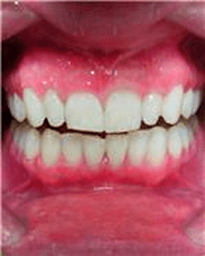 Zoom, tooth whitening, carbamide peroxide, after bleaching RB, Chris Castellano, best dentist near me, 33578, Riverview, Fl