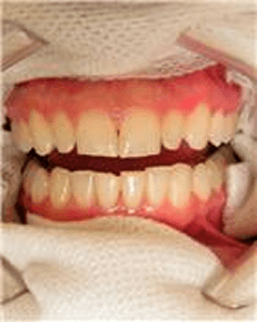 zoom 1hr bleaching, cosmetic bleaching before RB,Chris Castellano DMD, best dentist near me, 33578, Riverview, Fl.