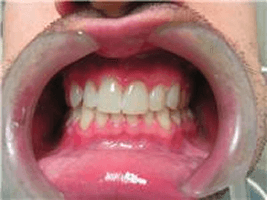 After Zoom, RO, Chris Castellano DMD, best dentist near me, 33578, Riverview, Fl.