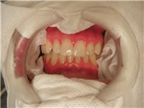 Zoom protection for cosmetic bleaching, Chris Castellano, best dentist near me, 33578, Riverview, Fl. top notch dentist