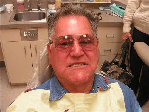 Full upper over full lower. implant bar overdenture. Chris Castellano DMD , top implant dentist , Riverview, Fl. 33578