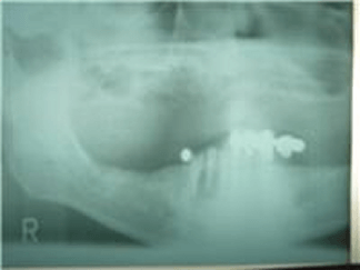 Panorex for implant treatment planning, top implant dentist Chris Castellano in riverview, Fl. 33578