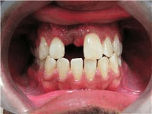 close up of 8 tooth knocked out before implant restoration Chris Castellano DMD , top implant dentist , Riverview, Fl. 33578