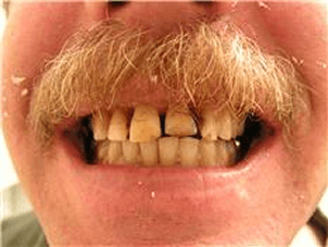 cosmetic restoration before. Chris Castellano DMD , top cosmetic dentist , Riverview, Fl. 33578