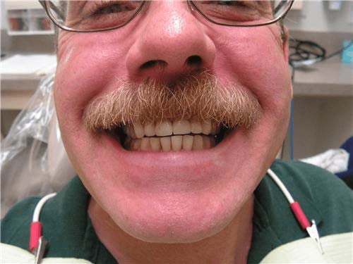 cosmetic restoration anterior teeth wide picture. Chris Castellano DMD , top cosmetic dentist , Riverview, Fl. 33578