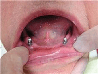 ball attchments on Chris Castellano DMD , top implant dentist , Riverview, Fl. 33578implants for overdenture retention.
