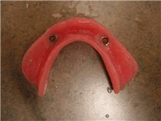 ball attachemnt over denture! Chris Castellano DMD , top cosmetic dentist , Riverview, Fl. 33578