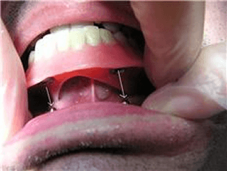 mechnical retention and path of insertion of ball overdenture. Chris Castellano, top implant dentist , Riverview, Fl. 33578