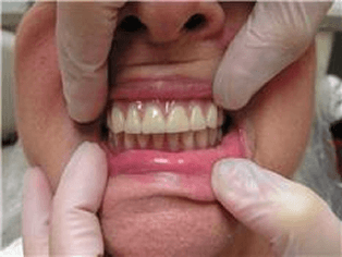full upper denture over full lower denture with 2 implant . Chris Castellano , top implant dentist , Riverview, Fl. 33578
