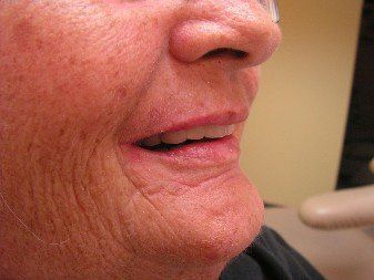 lateral view of restored full arch implants.