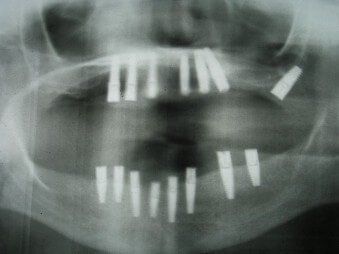 An x-ray of a person 's teeth with dental implants in them.